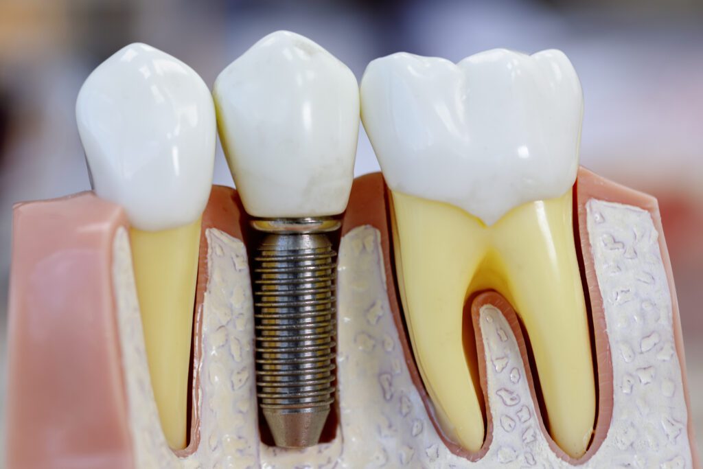 Single Dental Implants in Marshall, Texas