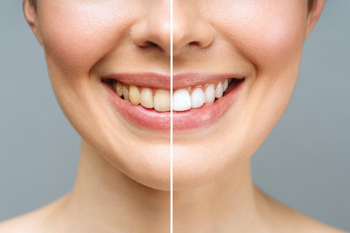 teeth whitening treatment in marshall, texas