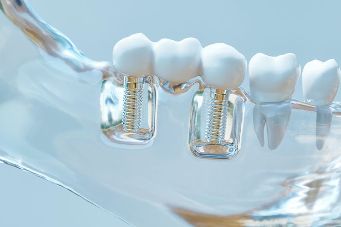 dental bridge treatment in marshall, texas