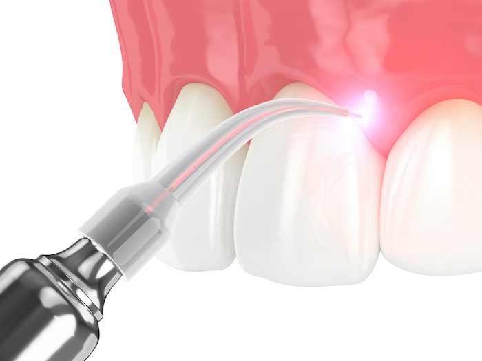 laser dental treatment in marshall, texas