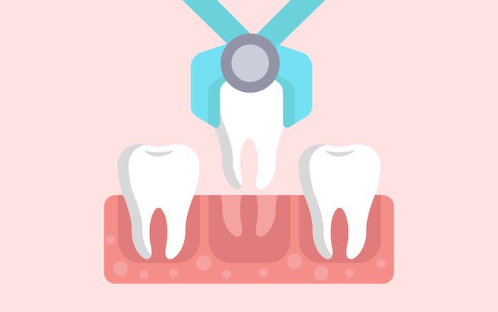 wisdom tooth extraction in marshall, texas